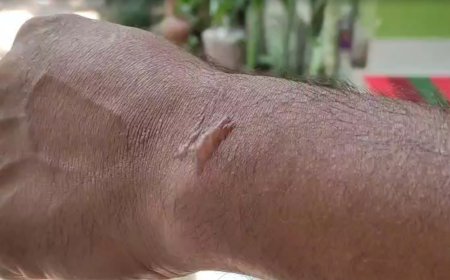 കട്ടപ്പനയില്‍ യുവാവിന് സൂര്യാതപമേറ്റു: കൈത്തണ്ടയില്‍ പൊള്ളലേറ്റ് കുമിളകള്‍ രൂപപ്പെട്ടു