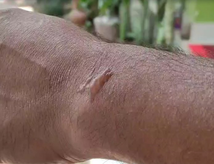 കട്ടപ്പനയില്‍ യുവാവിന് സൂര്യാതപമേറ്റു: കൈത്തണ്ടയില്‍ പൊള്ളലേറ്റ് കുമിളകള്‍ രൂപപ്പെട്ടു