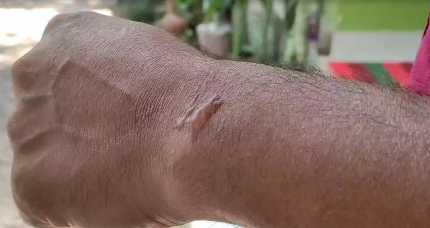 കട്ടപ്പനയില്‍ യുവാവിന് സൂര്യാതപമേറ്റു: കൈത്തണ്ടയില്‍ പൊള്ളലേറ്റ് കുമിളകള്‍ രൂപപ്പെട്ടു